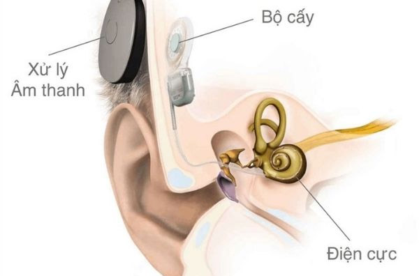 Cấy ốc tai điện tử giúp cải thiện thính lực, giảm nặng tai
